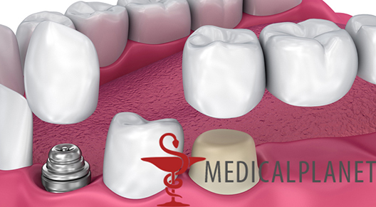 Medicalplanet.su — Коронка на зуб: какую выбрать и какова цена