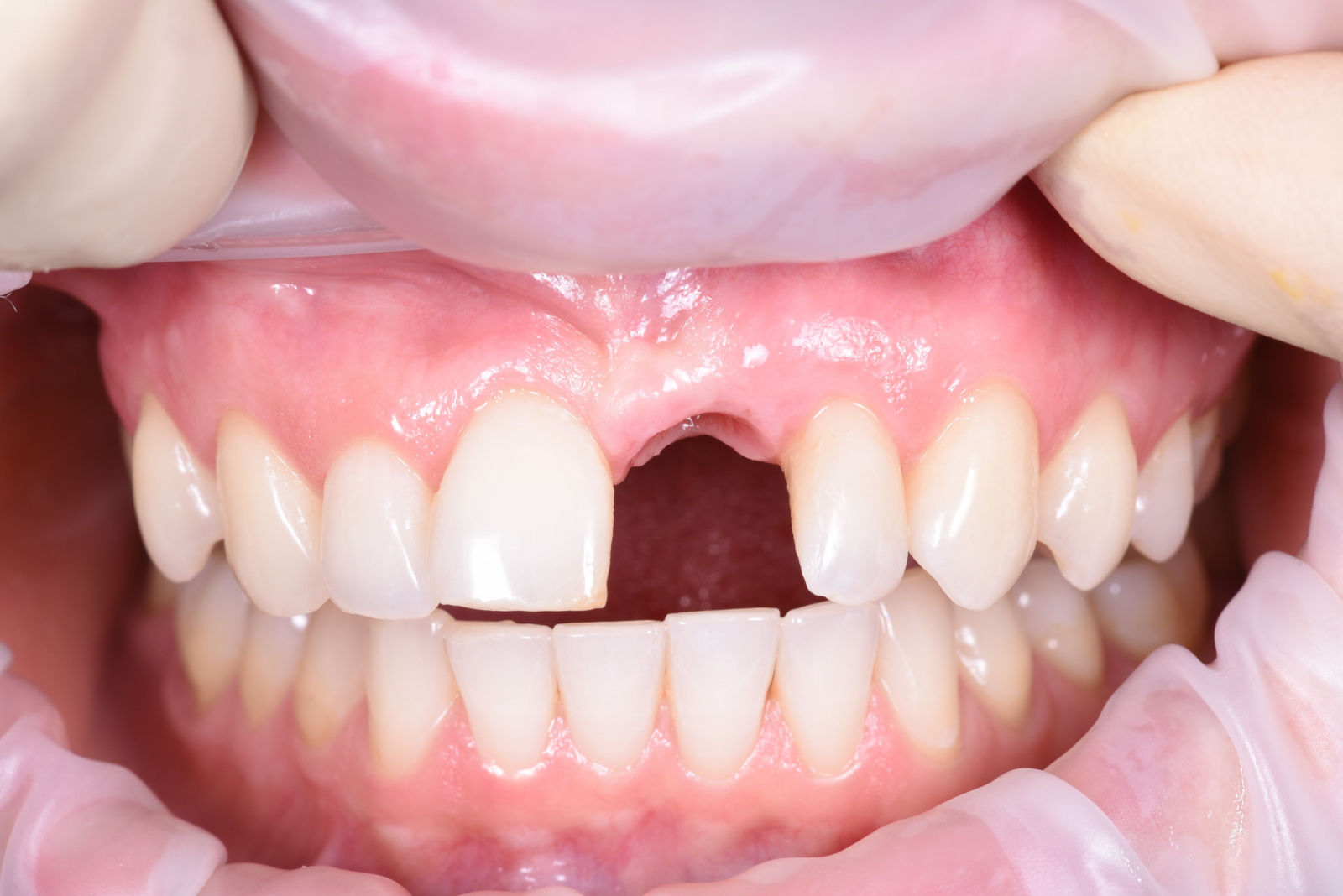 Работа врача: Установка имплантата 21-го зуба