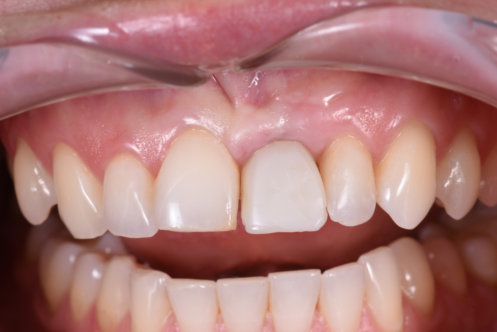 Работа врача: Установка имплантата 21-го зуба