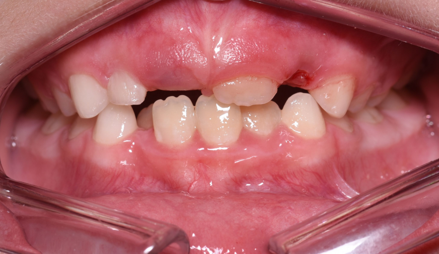 Работа врача: Исправление скученности зубов на нижней челюсти