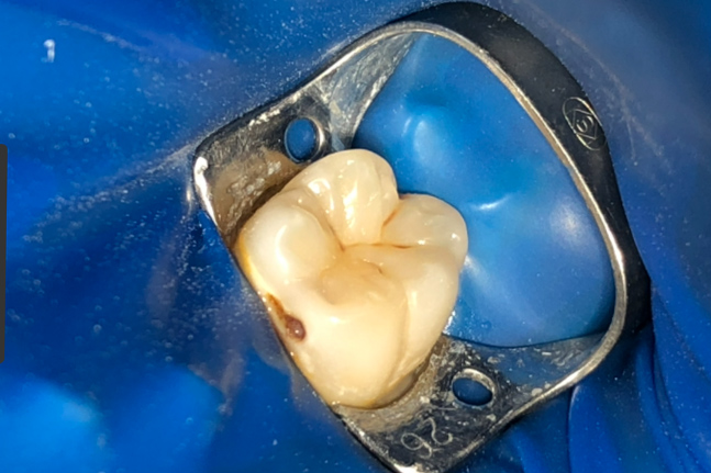 Работа врача: Лечение кариеса дентина 36 зуба