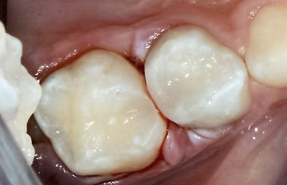 Лечение кариеса и пульпита зубов