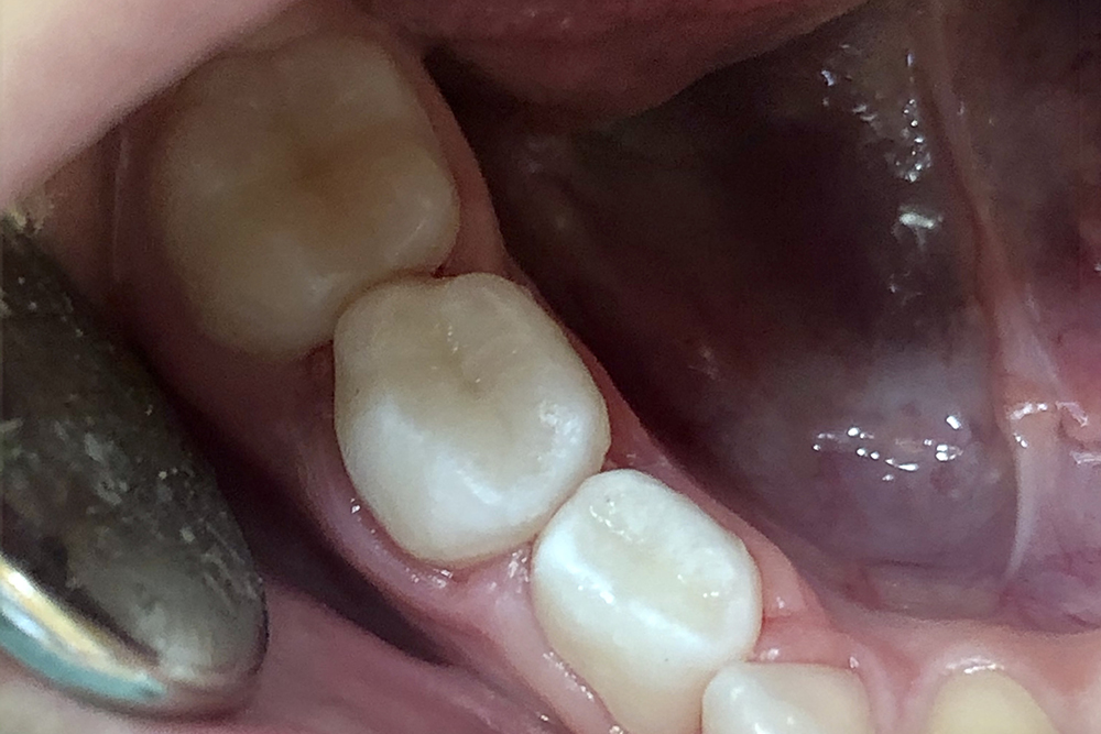 Работа врача: Лечение кариеса дентина 84 и 85 зубов