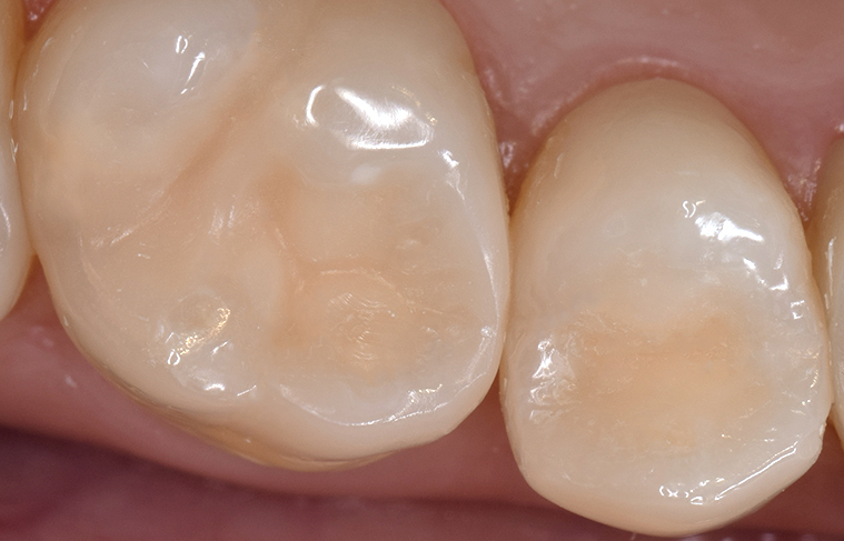 Работа врача: Восстановление зуба композитным материалом