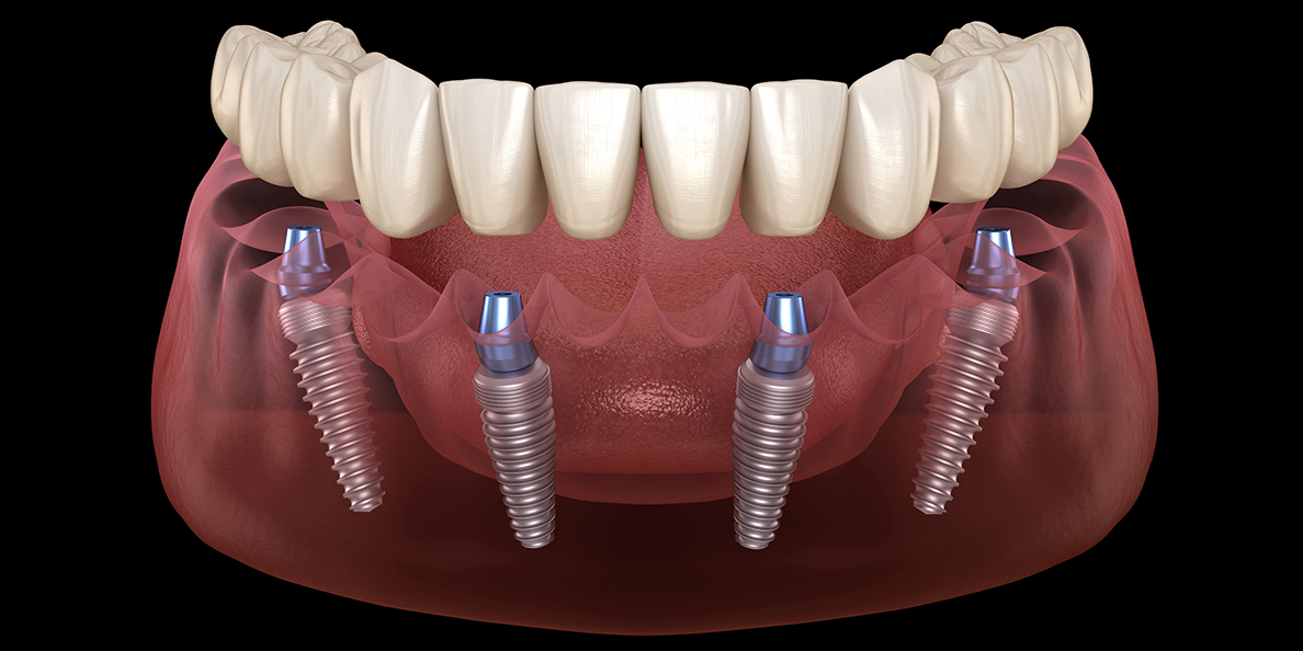 установка зубного протеза на 4 имплантах