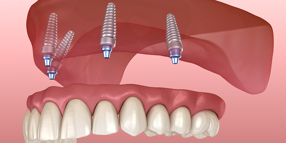 Все на 4 имплантах фото