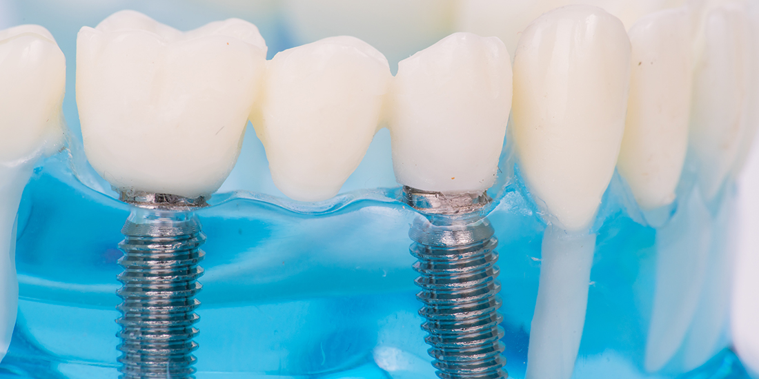 имплантация зубов под ключ в стоматологии