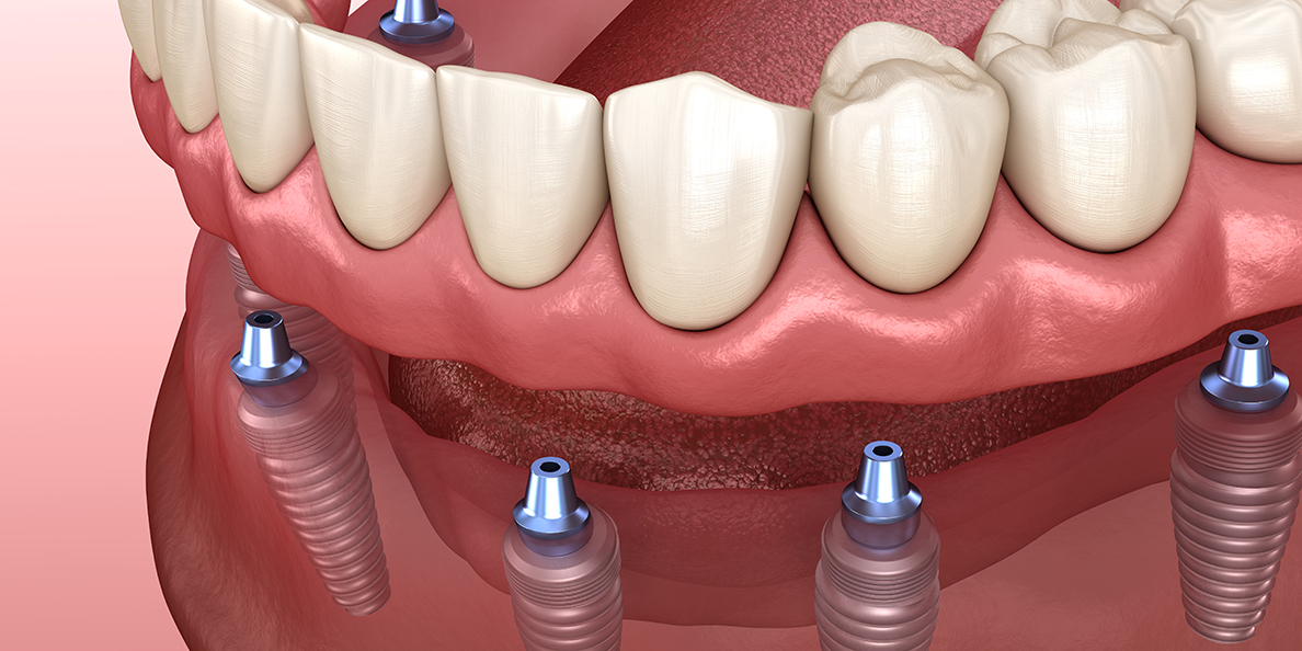 протезирование на 6 имплантах при полном отсутствии зубов