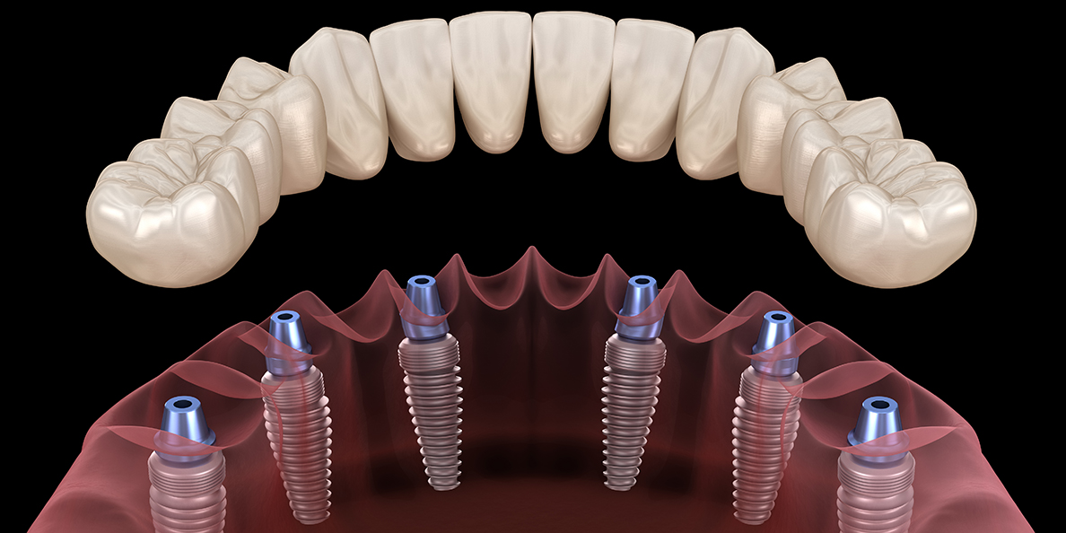 протезирование зубов на 6 имплантах