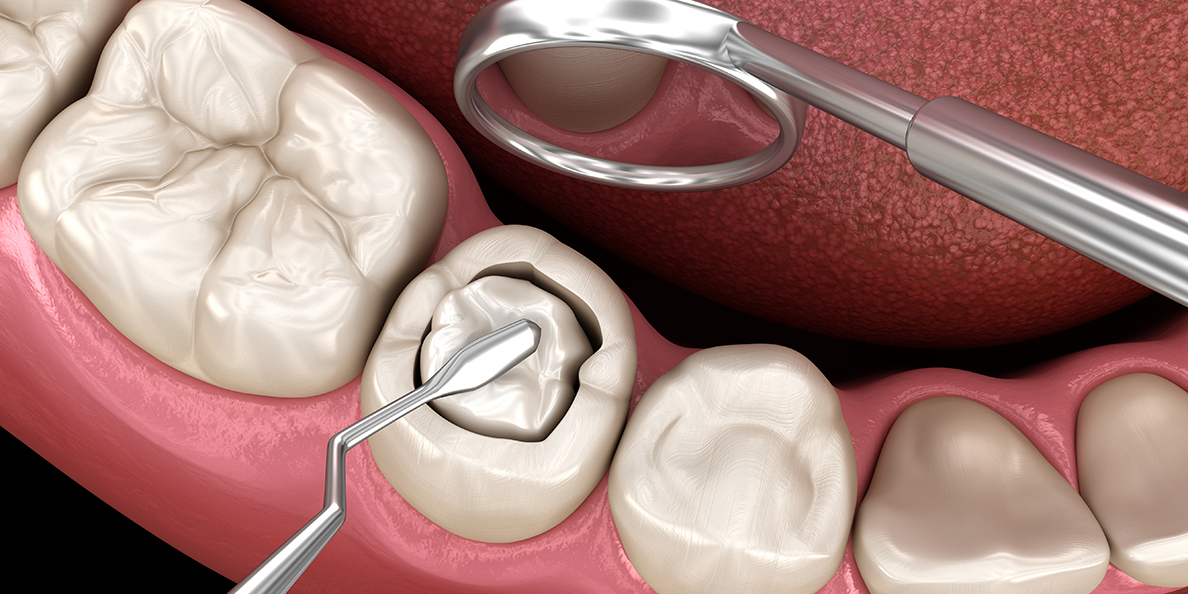 процесс композитной реставрации зуба