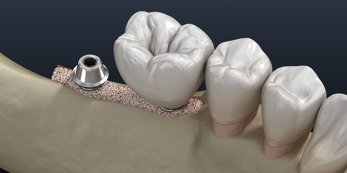 Наращивание кости с имплантацией в зубной клинике