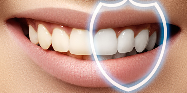 Зубы после отбеливания по технологиии Zoom 4