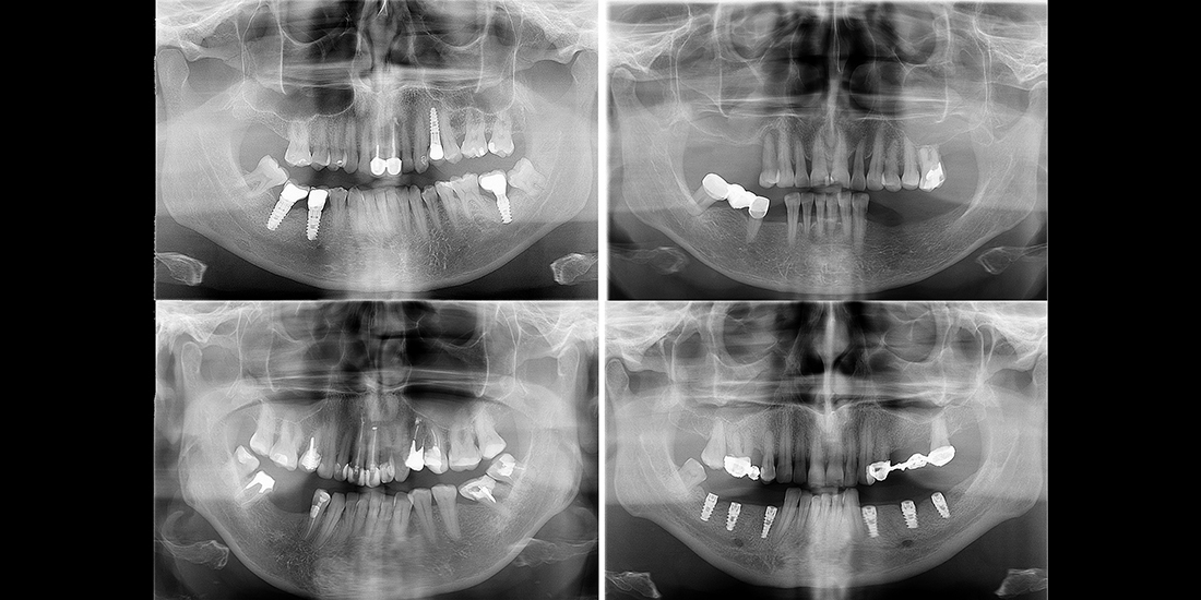 вид имплантов на панорамном снимке зубов
