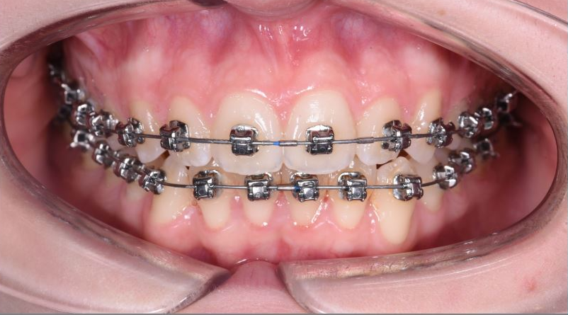 Корректировка зубных рядов брекет-системой Damon Q