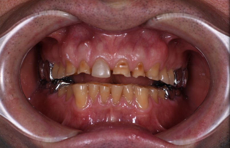 Работа врача: Косметическая реставрация зубов композитным материалом 