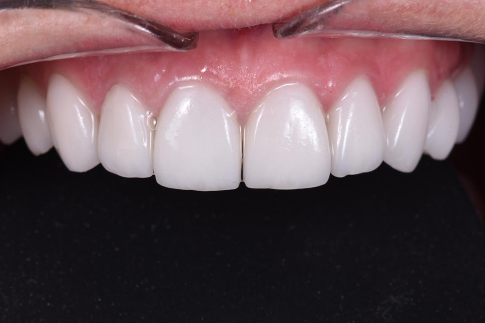 Работа врача: Удаление разрушенного зуба с установкой имплантата Nobel Biocare