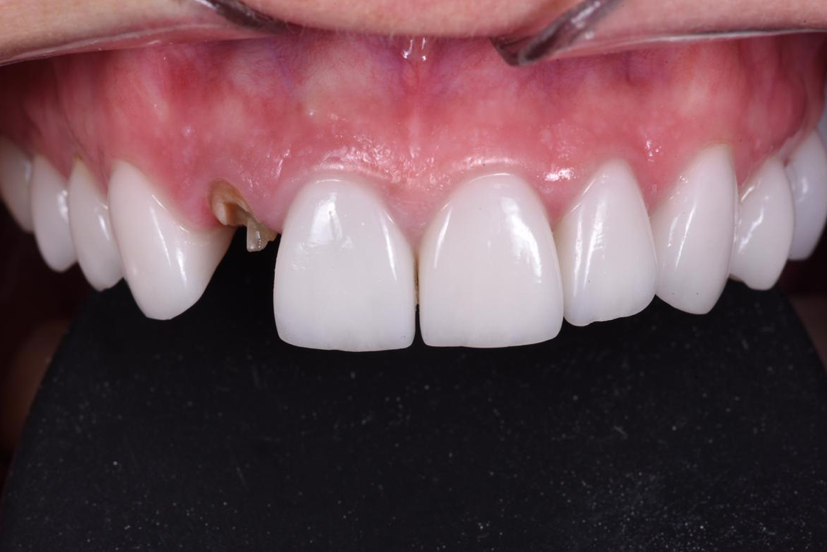 Работа врача: Удаление разрушенного зуба с установкой имплантата Nobel Biocare