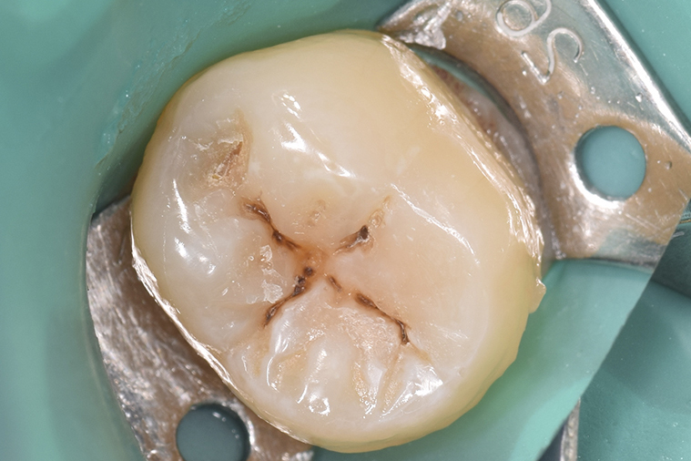 Работа врача: Прямая реставрация кариеса на зубе 3.7