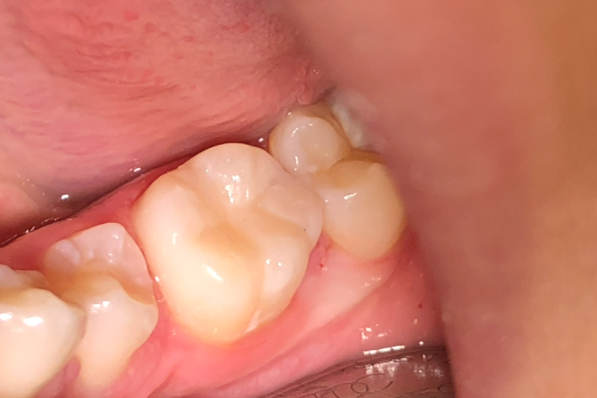 Лечение кариеса дентина 36 зуба