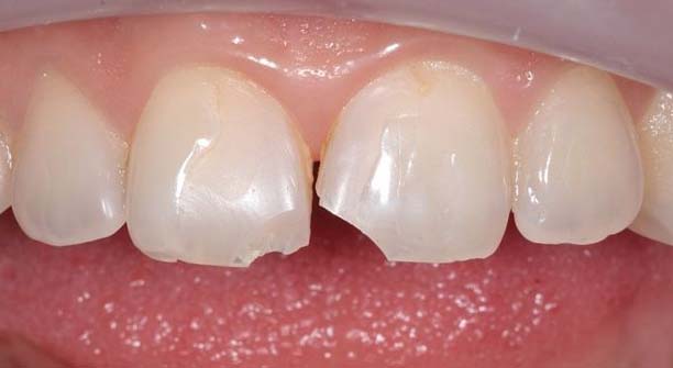 Сколы детских зубов: как могут помочь родители и стоматологи.